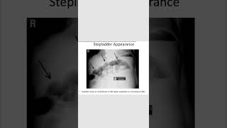 Stepladder appearanceradiology gitrevision neetpg inicet [upl. by Gnap]