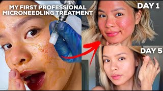 15 DAY HEALING POST PROFESSIONAL MICRONEEDLING  GIVEAWAY [upl. by Ediva]