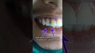 Mysterious Transformation of decayed toothComposite Restoration Front Tooth BeforeAfter filling [upl. by Beitris26]