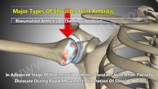 5 Major Types of Shoulder Arthritis Osteoarthritis Rheumatoid Septic Gout Pseudogout [upl. by Aneehc]