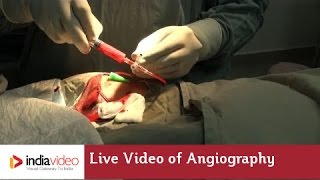 Live Video of Angiography at Lisie Hospital  How angiography is done [upl. by Ros258]