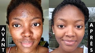 L ACNÉ COMMENT s en DÉBARRASSER 3 PRODUITS contre les boutons et les tâches🔥  SKINCARE ROUTINE💦 [upl. by Livvie]