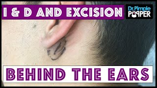 Popping large cyst behind ear [upl. by Chipman]