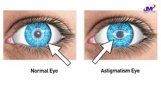 O que é Astigmatismo [upl. by Armstrong554]