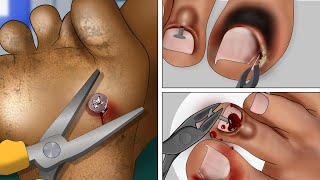 ASMR Animation Screw nail removal  Toenail Treatment [upl. by Kelly]