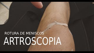 Día 17 Operación de Rodilla artroscopia rotura de menisco asa de cubo Mi experiencia [upl. by Pietro920]