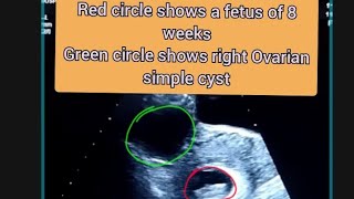 8 weeks Fetus Ultrasound  Right Ovarian cyst Ultrasound [upl. by Chaker]