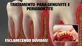 Tratamento para Gengivite e Periodontite  Esclarecendo Dúvidas [upl. by Ydnor]