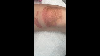 Plasma Pen Treatment for Creapy Skin on the Knees [upl. by Burrus789]