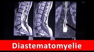 Diastematomyelie  Magnetresonanztomographie  by Radiologie TV [upl. by Aihseit699]