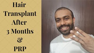 Hair Transplant after 3 months and PRP [upl. by Ecinereb]