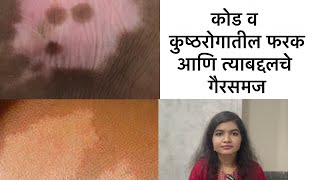 Vitiligo myths leprosy myths कोड व कुष्ठरोग गैरसमज [upl. by Dorion547]