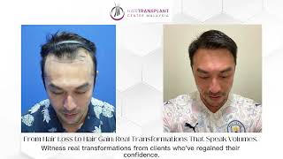 HAIR TRANSPLANT MALAYSIA  WELCOME TO OUR CLINIC [upl. by Amahcen]