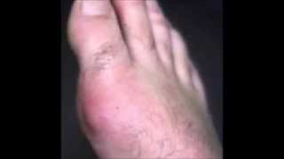 Pictures of Gout and Tophaceous Gout [upl. by Kaitlyn]