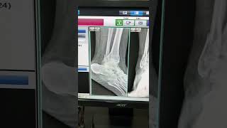 Fibula bone fracture  shorts video [upl. by Elleina867]