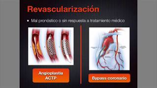 Cardiopatía isquémica 1 ¡Todo lo que debes saber [upl. by Coe566]