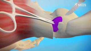 Bursitis de Trocánter y Tendinopatía Glutea Severa [upl. by Ahsinra]