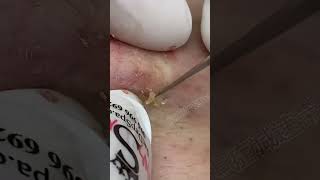 Blackhead Removal Acne Removal Treatment 09 [upl. by Hughmanick311]