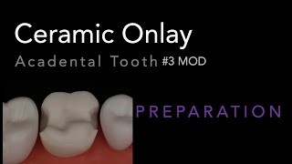 MOD Ceramic Onlay 3 Acadental  Dr Richard Stevenson [upl. by Alema420]