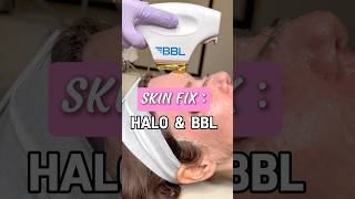 Achieve glowy skin with Halo amp BBL laser aesthetics medspa skin laser glowyskin beauty [upl. by Annairdua501]