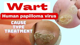 wart  मस्सा   cause type treatment  nursing class in hindi  human papilloma virus [upl. by Reade]