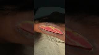 Ulcer examination  A complete overview [upl. by Jedidiah457]