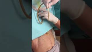 Suprapubic Catheter Change [upl. by Ennahoj]