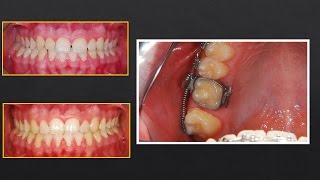 Molar distalization in Orthodontic Treatment Orthodontics [upl. by Grimbly]