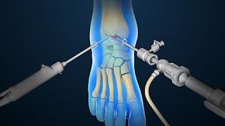 Ankle Scope  Arthroscopy  Nucleus Health [upl. by Nedrud277]