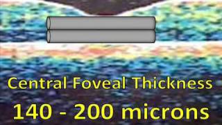 What is Macular Edema  Aftereffects of a CRVO [upl. by Norvun]