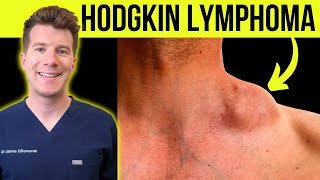 Doctor explains WARNING SYMPTOMS and SIGNS of HODGKINS LYMPHOMA CANCER [upl. by Saval]