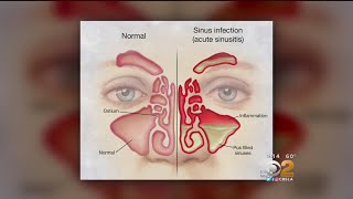 Doctor Tried And True Methods For Sinus Relief Are Still Best [upl. by Tremayne938]