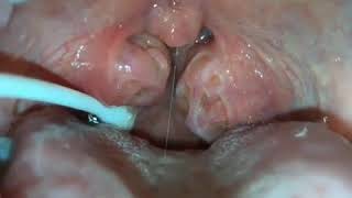 How to remove caseum from your tonsils [upl. by Aurelea]