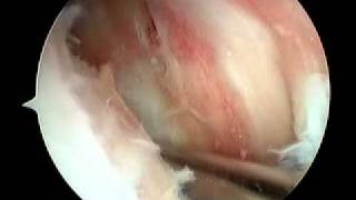 Knee Arthroscopy  Gout [upl. by Olaf96]