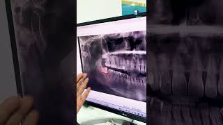 வலிக்காத ஞானப் பல்லையும் எடுத்து விடுங்கள்  Preventive Extraction of Wisdom Tooth  Denta Kings [upl. by Johst]