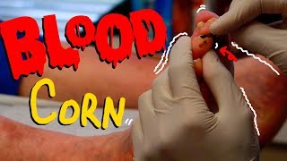 Satisfying BLOOD Corn Removal without any BLOOD [upl. by Alamac]