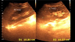 Fatty infiltration of the liver  Kidney Stone [upl. by Auqinet]