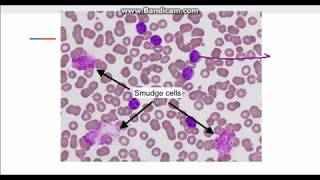 Chronic Lymphocytic Leukemia CLL [upl. by Sato803]