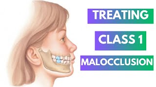 Management of Class 1 Malocclusion Orthodontics [upl. by Shellie337]