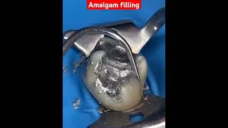 amalgam filling for class 1cavity dentalcaredentaltreatment [upl. by Dehnel509]