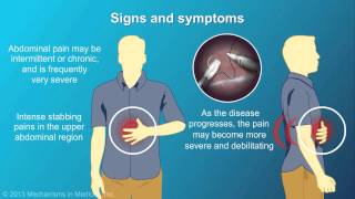 Chronic Pancreatitis [upl. by Rosaleen731]