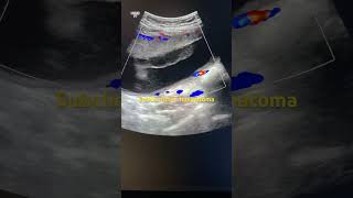 Pregnency ultrasound subchorionic haematoma [upl. by Zzaj]