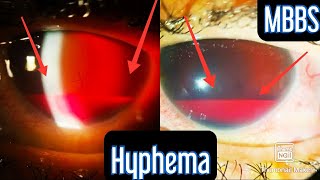 Injury to the eye Hyphema medicine mbbs neetpg usmle inicet neet aiims ophthalmology [upl. by Tsirc]