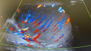 Ultrasound of Beautiful epididymo orchitis [upl. by Odlaumor917]