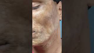 Morphea  Scleroderma  एक साधारण बीमारी भी इलाज के अभाव में काफी ख़तरनाक रूप ले सकती है  morphea [upl. by Tad578]