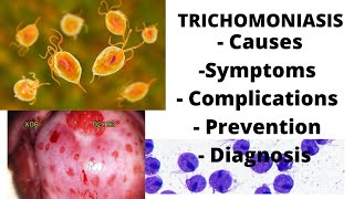 Trichomoniasis  symptoms causes complications prevention amp diagnosis [upl. by Nahtnahoj336]