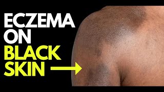 Doctor explains what ECZEMA looks like on BLACK SKIN  plus photos diagnosis and treatment [upl. by Anitnatsnoc36]