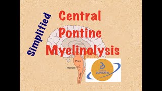 Central Pontine Myelinolysis Osmotic Demyelination Syndrome HYPONATREMIA in 6 min COMLEX USMLE [upl. by Strage427]