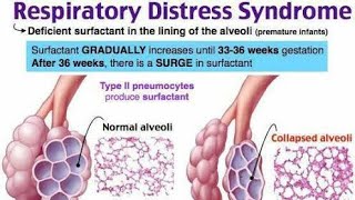 أوضح شرح لل Respiratory distress syndrome RDS in newborn في الأطفال [upl. by Inalak657]