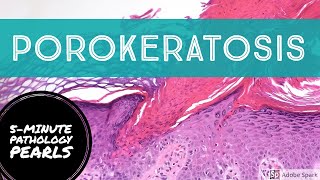 Porokeratosis 5Minute Pathology Pearls [upl. by Benedikt]